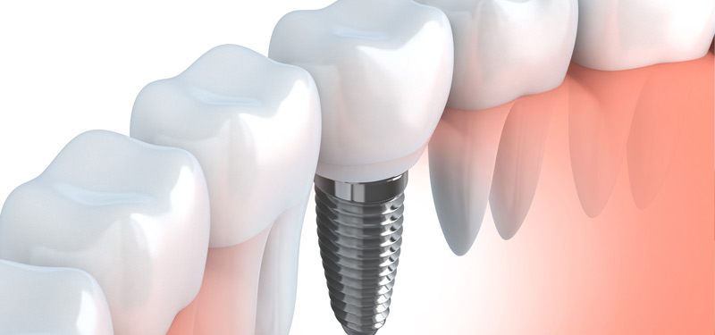 Dental Implants in mumbai