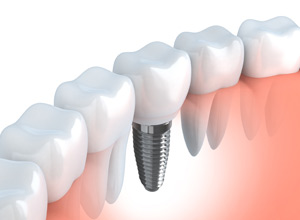 dental-implants